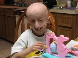 progeria3.webp