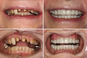 porcelain-crown-restorations-bridges-and-implants.webp