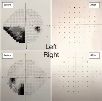 blind medical test.webp